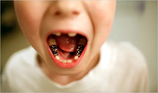 Ryan Massey, 7, shows his caps. Dentists near Charleston, W.Va., say pollutants in drinking water have damaged residents’ teeth. Nationwide, polluters have violated the Clean Water Act more than 500,000 times.