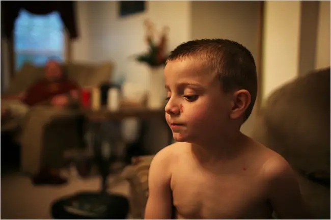 Clay Massey, 6, waits for his mother to put prescription ointment on painful scabs and rashes that she said were caused by polluted bath water.
